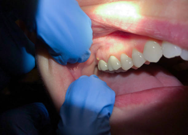 Best Emergency Root Canal Therapy in Ashland, AL